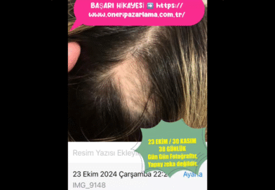 38 GÜNDE YENİ SAÇLAR NASIL ÇIKTI ? / HOW DID NEW HAIR GROW IN 38 DAYS?